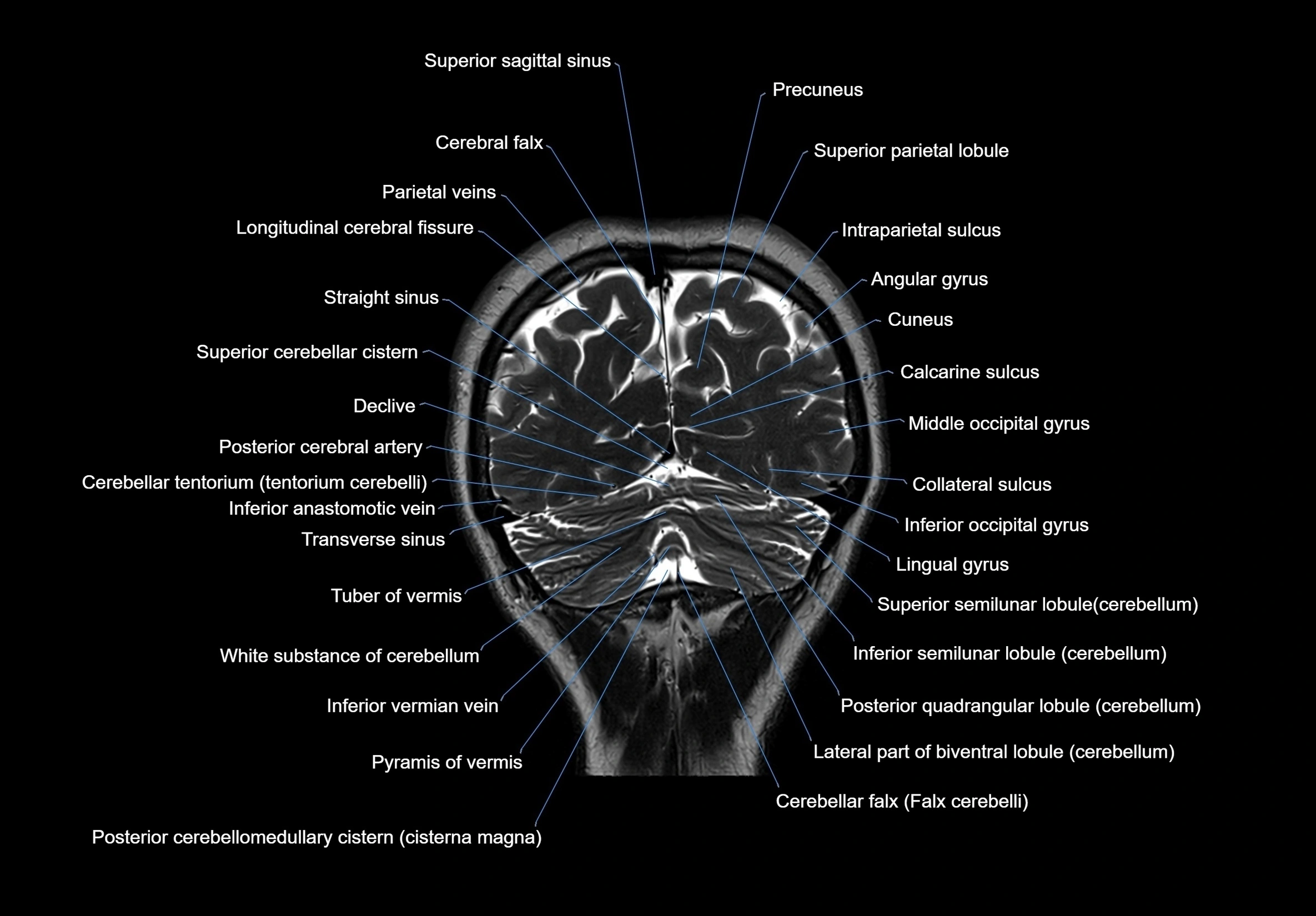 MRI Brain coronal cross sectional labelled anatomy 3T image  -img-00001-00061.webp